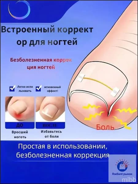 Комплект из 10 никелид-титановых корректоров для вросших ногтей