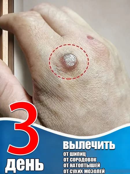 Безболезненное удаление бородавок без следов: сосочковые, остроконечные кондиломы, родинки и подошвенные бородавки исчезают за 7-10 дней. Безопасное и эффективное восстановление кожи.