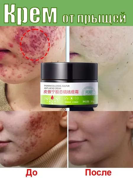ANTI-ACNE Крем для лица от акне прыщей воспалений 30г,от черных точек и угрей, жирной и чувствительной кожи,Подходи