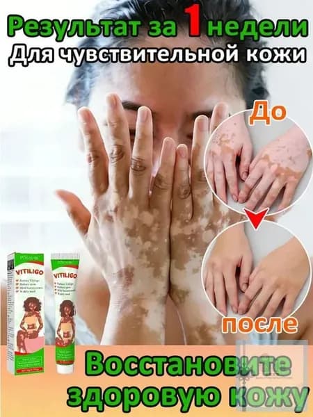 Мазь от витилиго,Средство при нежелательной пигментации витилиго.100 мл