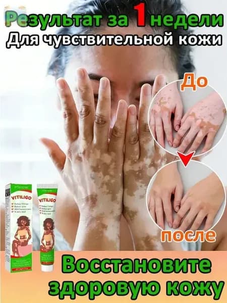 Мазь от витилиго,Средство при нежелательной пигментации витилиго.60 мл