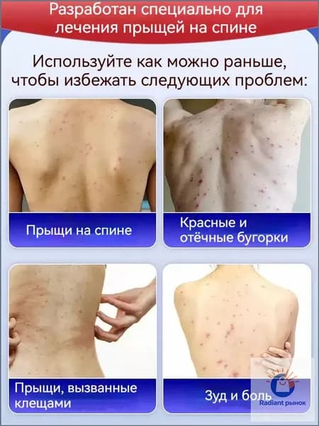 Мазь от чесотки для людей эффективное средство от чесотки и зуда, быстродействующая