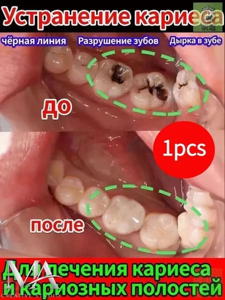 Зубная паста для дырки в зубе, глубокого кариеса и пульпита, Снимает боль, восстанавливает при поражении кариесом у взрослых, Свежее дыхание, 100 г, 1 шт.