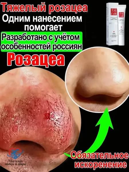 Крем от купероза для лица покраснений на лице и розацеа,Куперофаг Крем от купероза на лице, антикупероз, средство от сосудистых звездочек, от покраснений, розацеа,Китайская чудо-мазь.20 г