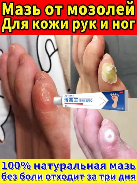 Эффективный крем для быстрого избавления бородавок, мозольный удаления мозолей, натоптышей 20 г