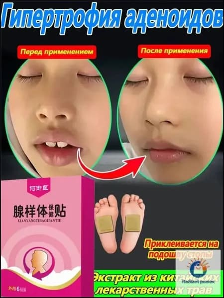 Пластырь традиционной китайской медицины от гипертрофии аденоидов Xiuyishu для коррекции детского лица, 1 коробка