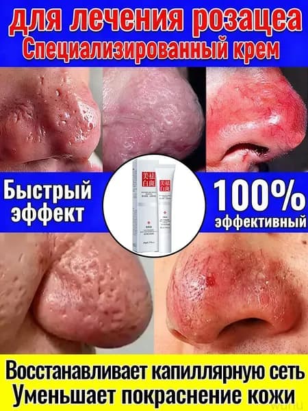 Мазь от розацеа, используемая при куперозе и покраснении лица, для уменьшения покраснения и отека носа, при липкой и жирной коже, китайская чудо-мазь, 20 грамм
