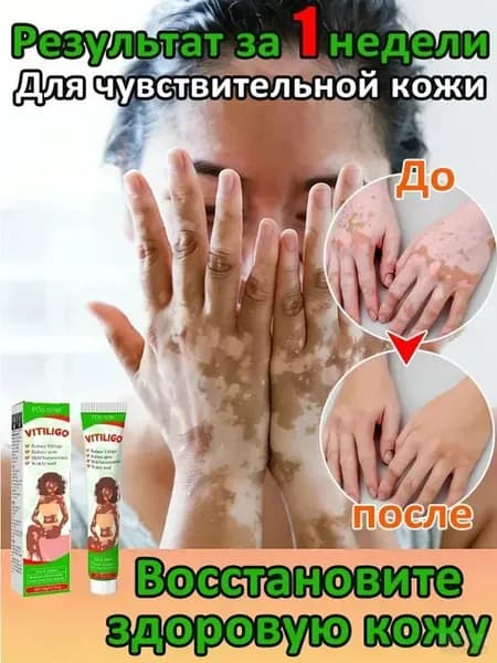 Мазь от витилиго,Средство при нежелательной пигментации витилиго.20 мл