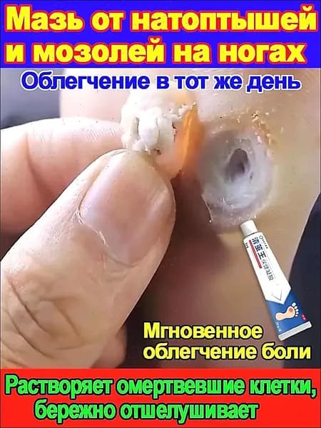 Китайская Чудл Мазь средство от папиллом и бородавок. Эффективный крем для быстрого избавления бородавок, мозольный удаления мозолей, натоптышей 20 г