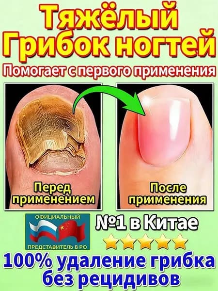 Противогрибковая мазь Ноготок от грибка ногтей на ногах и гиперкератоза, противогрибковое средство для ног,укрепляйте и восстанавливайте ногти
