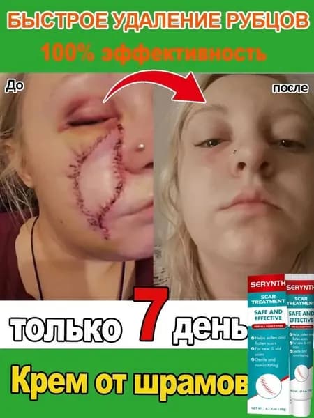 Крем для удаления шрамов. Быстро удаляет шрамы, растяжки, следы от акне и ожогов. Мягкий и не раздражающий, подходит как мужчинам, так и женщинам. 20 мл