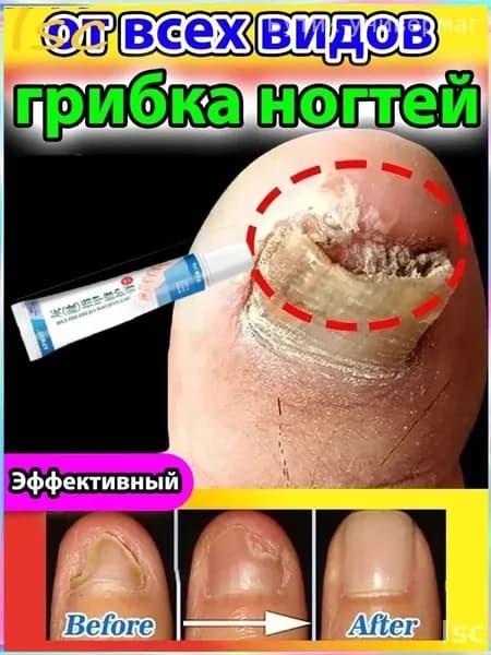 Мазь-крем Ноготок противогрибковая для ногтей - от грибка ногтей на ногах и гиперкератоза