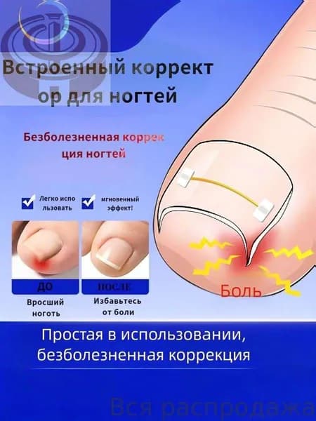 Комплект из 10 никелид-титановых корректоров для вросших ногтей