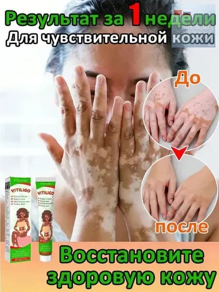 Мазь от витилиго,Средство при нежелательной пигментации витилиго.20 мл