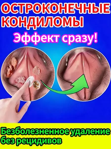 Крем от остроконечных кондилом с травяным комплексом направленное действие и восстановление
