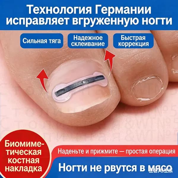 Набор для коррекции вросшего ногтя из никель-титанового сплава домашнего лечения
