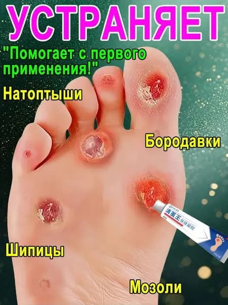 Эффективный крем для быстрого избавления бородавок, мозольный удаления мозолей, натоптышей 20 г