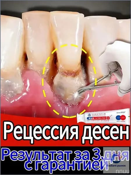 Восстановление десен и укрепление зубов при рецессии - гель с регенерирующим кремнием