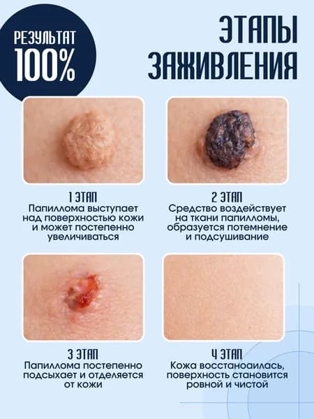 Чистотел от папиллом и бородавок, гель от папиллом, от натоптышей, от мозолей, Papil Stop,