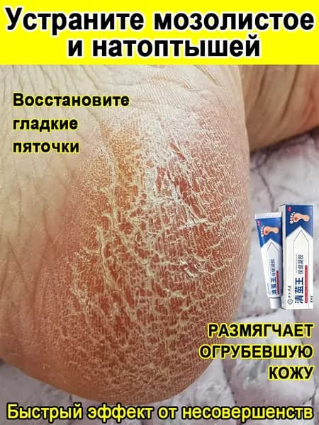 Mазь от мозолей стержневых и натоптышей ,Крем от сухих мозолей,бородавок, трещин на пятках и натоптышей,20 г.