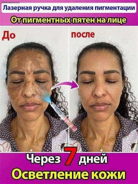 Лазер от веснушек,используемый для удаления веснушек,меланодермии,пигментных пятен,солнечных ожогов,красоты лица,безболезненный и без побочных эффектов