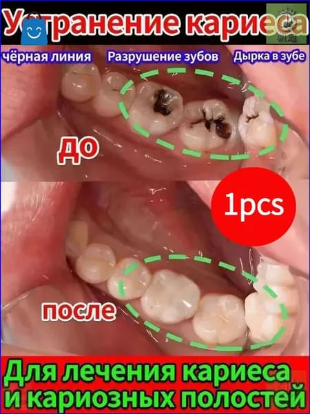 Зубная паста для дырки в зубе, глубокого кариеса и пульпита, Снимает боль, восстанавливает при поражении кариесом у взрослых, Свежее дыхание, 100 г, 1 шт.