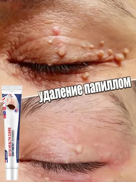Профессиональный крем от бородавок, эффективный против обычных бородавок, папиллом и кератином, бережно удаляет их, не повреждая здоровую кожу, 20 г