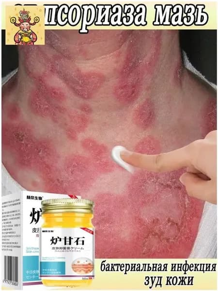Крем мазь от псориаза, мазь при кожных заболеваниях. Гель от акне, экземы, дерматита, грибка, герпеса, угрей, сыпи и покраснений 50 гр.