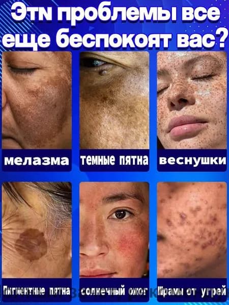 Лазерная указка от пигментации портативная для удаления веснушек и пятен, белый