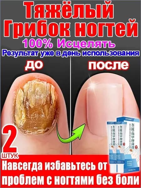 Популярный крем для ногтей от грибка и гиперкератоза, мазь для ноготков на ногах, 2 штуки