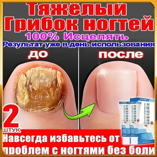 2 штуки,крем ноготок от грибка ногтей на ногах,ноготок мазь от грибка на ногах,гиперкератоз