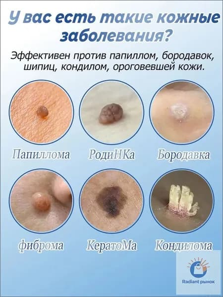 Популярное средство для избавления от новообразований, бесследно устраняющее папилломы, родинки и бородавки, без шрамов и нежелательных реакций, 20 г