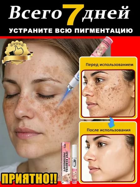 Лазерное лечение веснушек и пигментных пятен: улучшает состояние кожи лица, выравнивает тон кожи, удаляет пигментные пятна, веснушки, пятна от солнечных ожогов, мелазму, угревую сыпь и морщины.