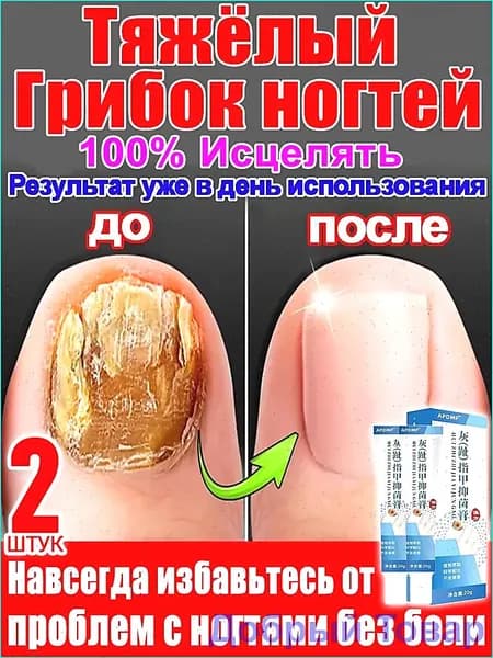 2 штуки,крем ноготок от грибка ногтей на ногах,ноготок мазь от грибка на ногах,гиперкератоз