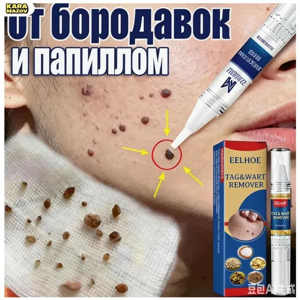 Эксклюзивный стержень от папиллом и родинок 3 мл, удаляющий бородавки без боли и следов, с отсутствием побочных эффектов- karamazov