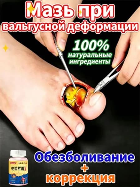 Мазь от вальгусной деформации большого пальца ноги, обезболивающее средство для коррекции косточки на стопе, натуральный состав