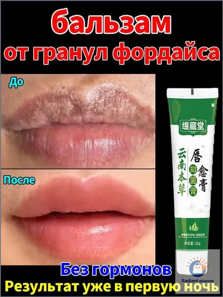 бальзам от гранул фордайса