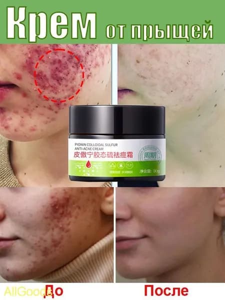 ANTI-ACNE Крем для лица от акне прыщей воспалений 30г,от черных точек и угрей, жирной и чувствительной кожи,Подходит для лица, ягодиц и тела, для подростков и взрослых