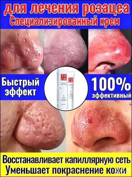Эксклюзивный крем против розацеа и расширенных капилляров, 30 г, расширение сосудов и жирная кожа, одновременно устраняет отечность носа. ...
