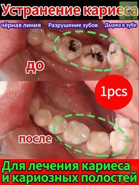 Восстановление десен и укрепление зубов при рецессии - гель с регенерирующим кремнием
