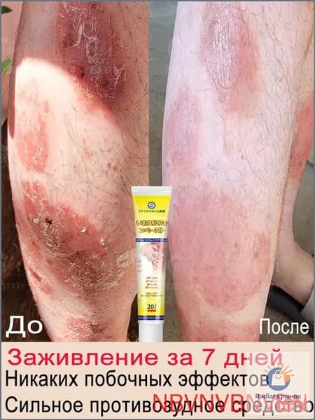 Тело крем от псориаза Противозудное, антибактериальное средство при экземе и герпесе