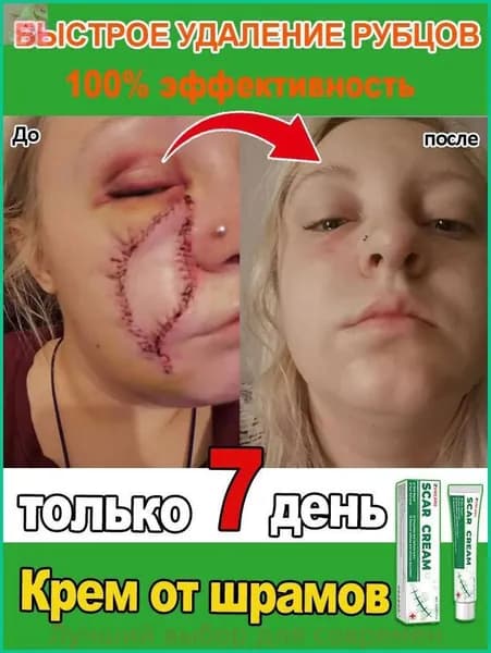 Крем для удаления шрамов. Быстро удаляет шрамы, растяжки, следы от акне и ожогов. Мягкий и не раздражающий, подходит как мужчинам, так и женщинам. 20 мл
