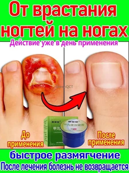 Спрей от грибка ногтей на ногах лечение, укрепление и восстановление. 15g