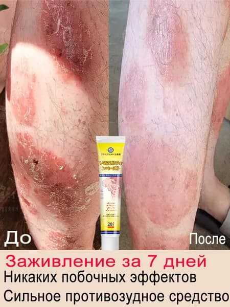 Тело крем от псориаза Противозудное, антибактериальное средство при экземе и герпесе
