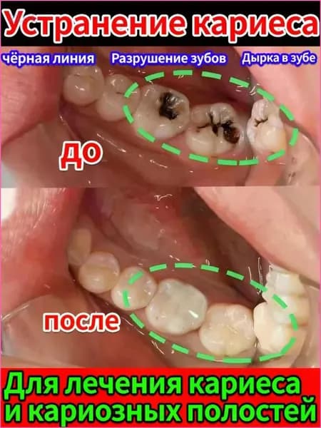 Зубная паста, которая заделывает дырки и лечит кариес! Восстановление эмали, снятие боли при пульпите, защита от глубокого поражения.