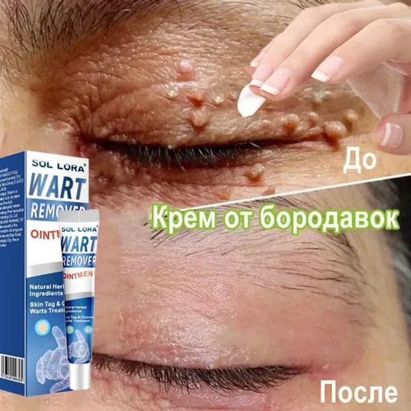 Средство от папиллом и бородавок, для удаления бородавок папиллом, сухих мозолей на ногах и теле, мазь от бородавок