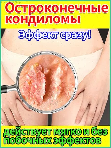 Крем для удаления остроконечных кондилом у женщин и мужчин. Лечение кондилом, папиллом и ВПЧ в интимной зоне и на коже. Средство от генитальных бородавок