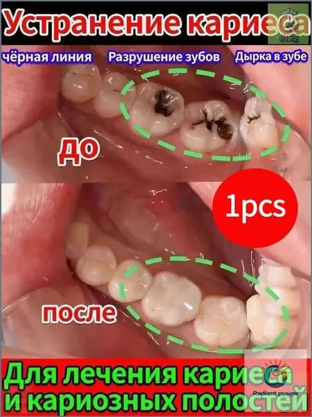 Зубная паста для дырки в зубе, глубокого кариеса и пульпита, Снимает боль, восстанавливает при поражении кариесом у взрослых, Свежее дыхание, 100 г, 1 шт.