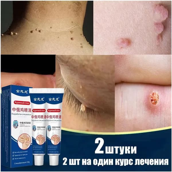 Быстрое удаление куриного глаза обеспечивается безопасным и не имеющим побочных эффектов популярным раствором для снятия бородавок.