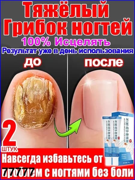 2 штуки,крем ноготок от грибка ногтей на ногах,ноготок мазь от грибка на ногах,гиперкератоз